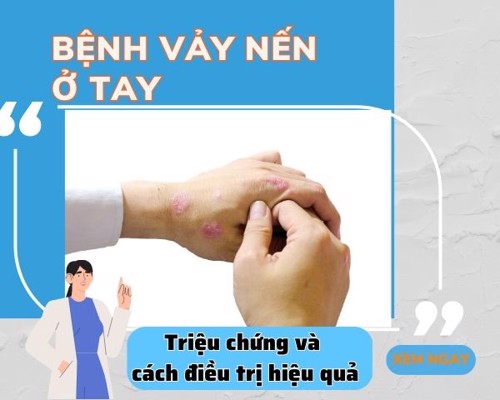 Bệnh vảy nến ở tay: triệu chứng và cách điều trị hiệu quả